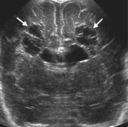 parietooksipital alanda tutulum ve >10mm kist varsa serebral palsi oldukça olası Daha küçük kistlerde