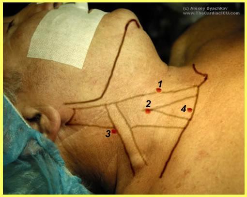 Santral yaklaşım: Sol elin parmakları sternokleidomastoid (SKM) kasının iki demetini ve karotis nabzını palpe etmek için kullanılır.