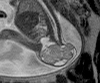 Spinal MRI Fetal MRG, kemik spinal anomalileri olan fetuslarda spinal kordun