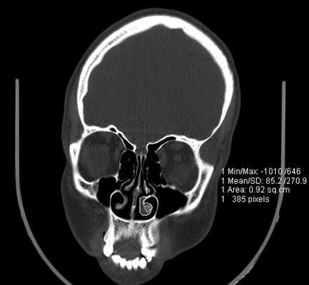 ay BT görüntüsü Şekil 13: RFTA gr. olgu 9 uin maksiler sinüs ostiumu seviyesinden koronal preoperatif ve postop.