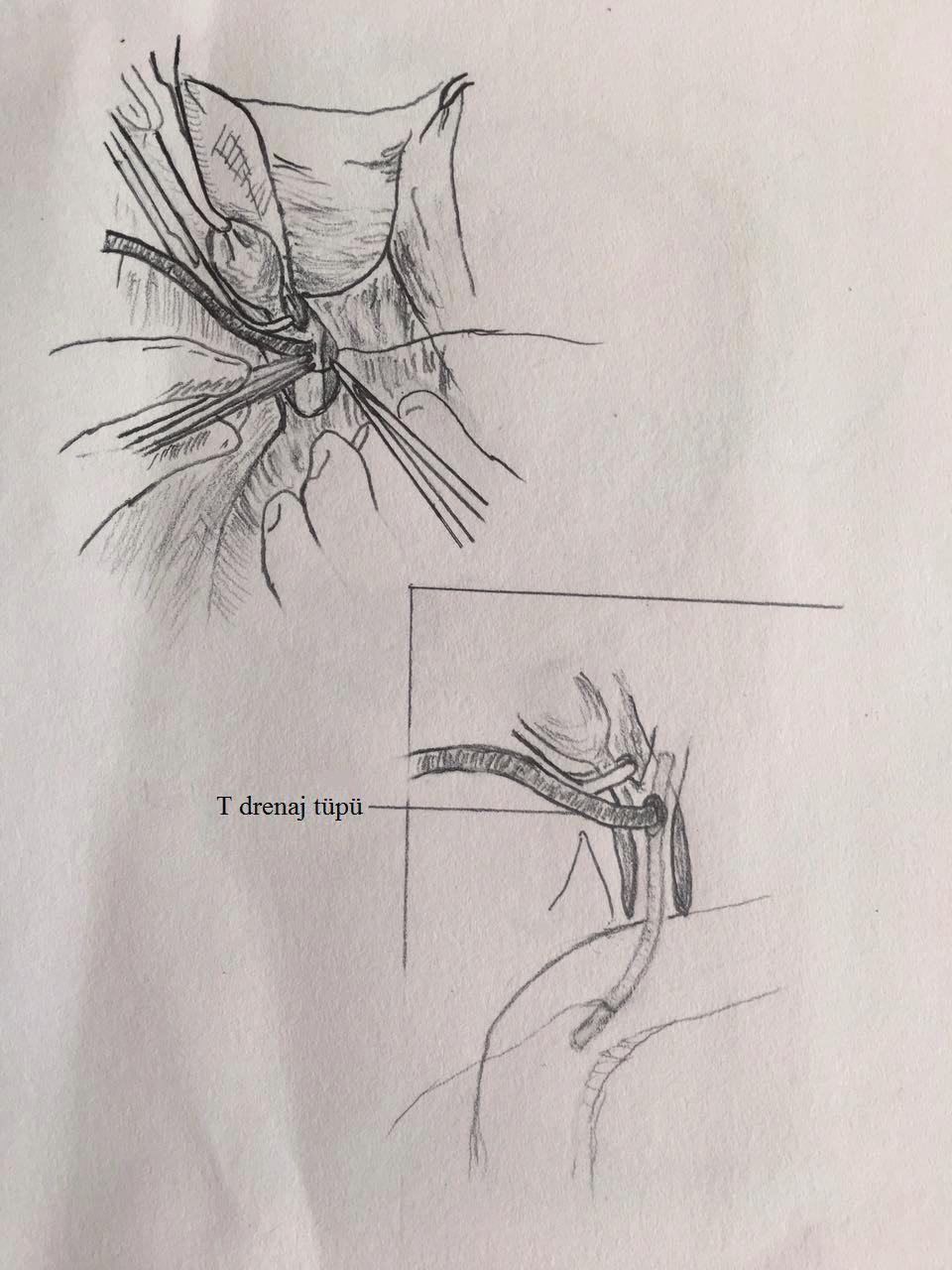 T tüpün alt ayağı duodenal drenaj amaçlı duodenumda yaklaşık 10 cm lik alanı drene edecek şekilde yerleştirilir(resim 3). Duodenotomi 3-0 vikril sütür kullanılarak çift kat üzerinden onarılır.