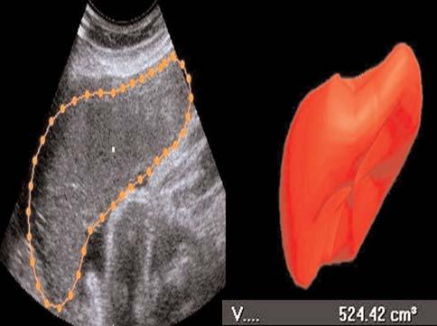 Üç boyutlu ultrasonografi ile ölçülen plasenta hacminde cinsiyete ba l de iflim gebelik ve postterm gebelik de erkek fetüslerde daha s k görülürken, hiperemezis gravidarum ve plasenta invazyon