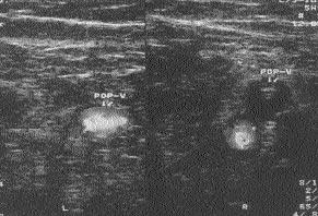 Sa popliteal ven normaldir que 350) ve 26 hastada 120 ml iopromide (Ultravist 370) kullan ld.