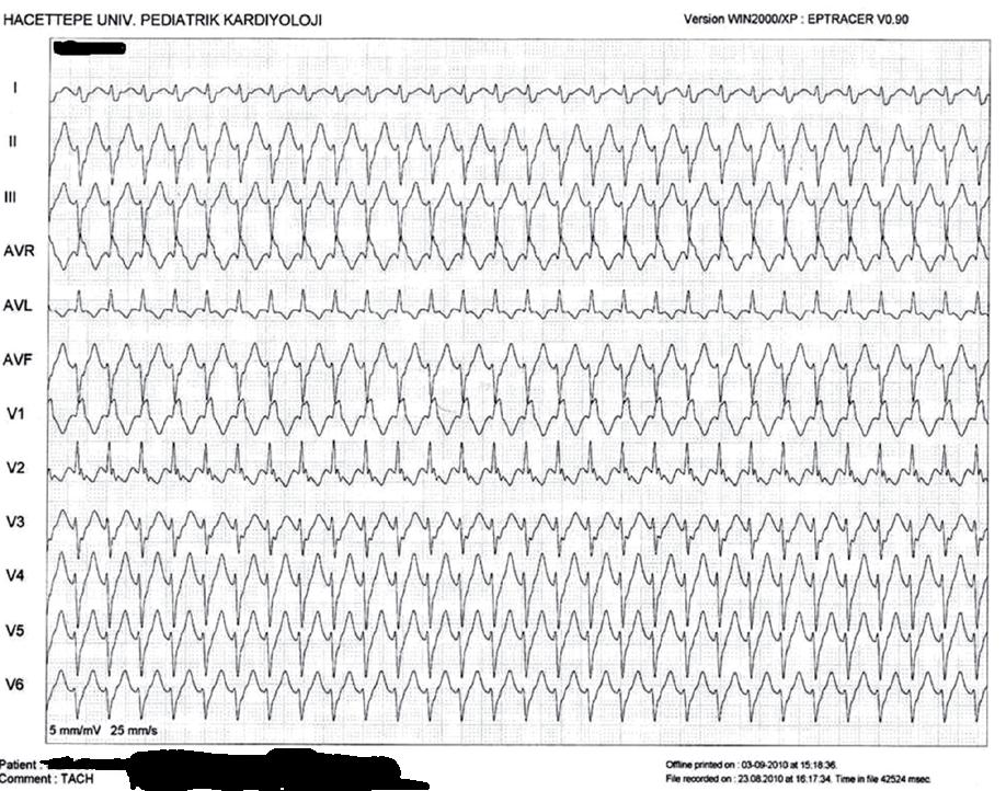 Çocuklarda İdiopatik Sol Ventrikül Taşikardisi 25 ŞEKİL 1 Elektrofizyoloji laboratuarında taşikardi esnasında alınan 12 lead EKG kaydı (6 no lu hasta) Fasiküler ventriküler taşikardide