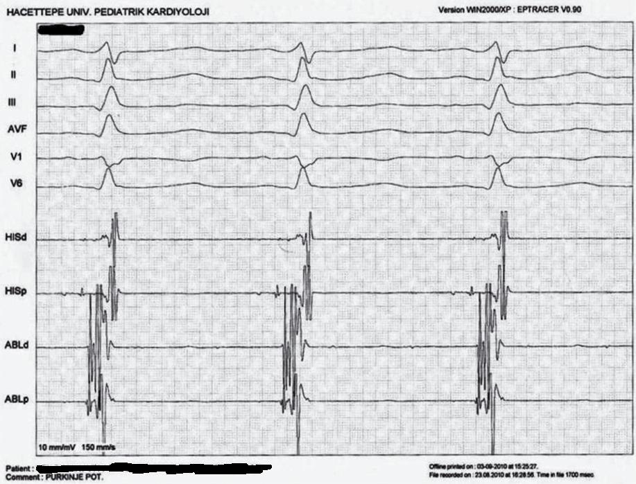 26 Türk Aritmi, Pacemaker ve Elektrofizyoloji Dergisi ŞEKİL 2 Radyofrekans kateter ablasyon, Purkinje potansiyellerinin olduğu yere uygulandı (hasta sinüs ritminde) (6 no lu hasta) oranında başarılı