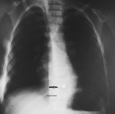 PA Akciğer Grafisi Genellikle sınırlı bulgulara rastanır.