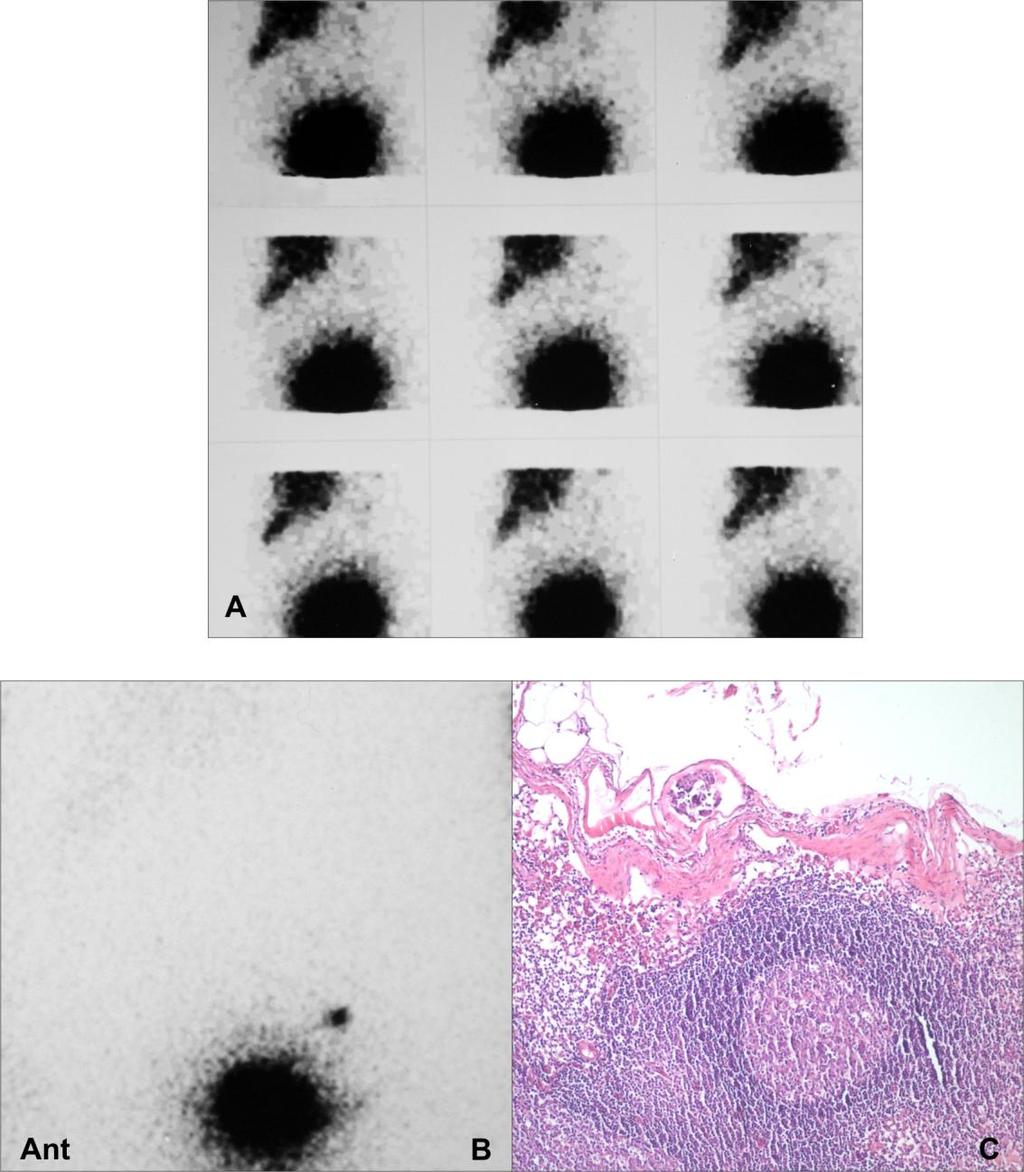 73 Şekil 4.8. 69y, Evre IIA, Endometrium Kanseri (Hasta no 14) Dinamik (A), 30.