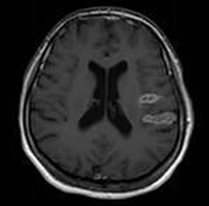 Ayn bölgede çevresel kontrast tutulumu gösteren subakut infarkt ile uyumlu görünüm izlenmekte. bulgu saptanmad ve tromboembolik risk nedeniyle varfarin kullan m na devam edildi.