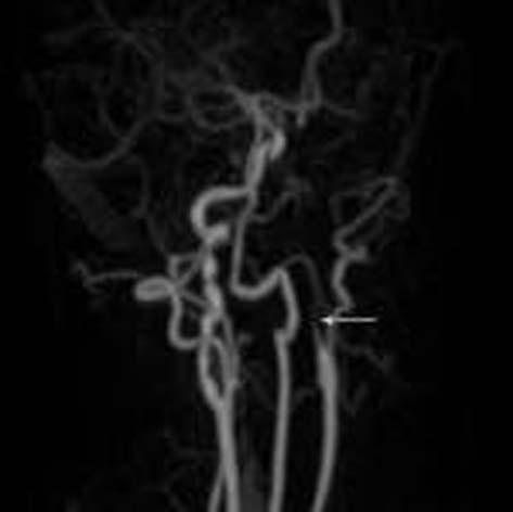 nme genellikle diseke arter lümeninden intrakraniyal damarlara emboli sonucu olup, genellikle orta serebral artere do rudur.