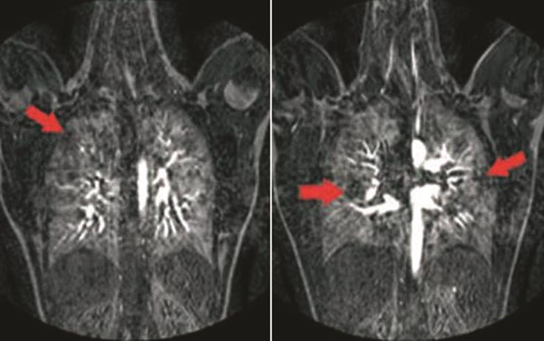 Kronik Kompleman Aktivasyonundan Kaynaklanan Pulmoner Hipertansiyon Vasküler direnç artışı ve kardiyak disfonksiyon ile birlikte pulmoner hipertansiyon (PHT) meydana gelir PNH li hastalarda PHT,