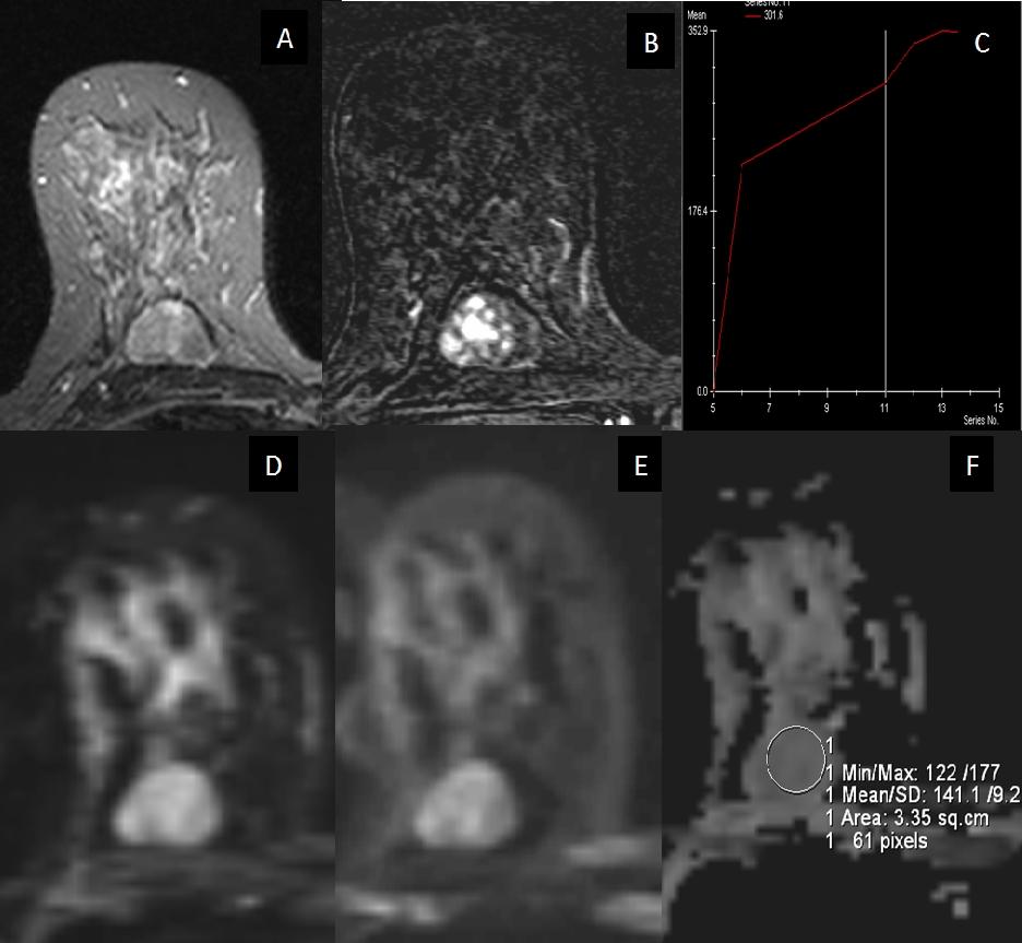 V. OLGU ÖRNEKLERİ OLGU 1. Histopatolojik tanısı fibroadenom olan, 41yaşında kadın olgunun konvansiyonel ve difüzyon ağırlıklı meme MR görüntüleri : TIRM (A) ve postkontrast subtrakte görüntüde (B) 2.