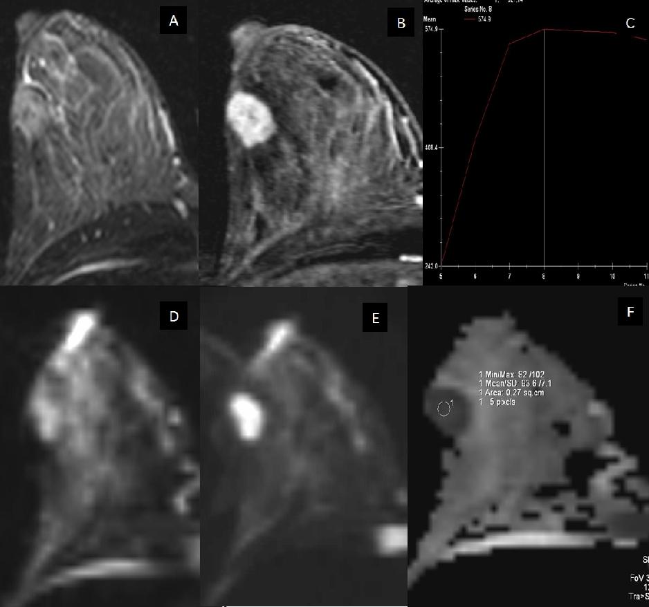 OLGU 3. 40 yaşında kadın olgunun konvansiyonel ve difüzyon ağırlıklı meme MR görüntüleri: TIRM (A) ve postkontrast subtrakte görüntüde (B) 1.7x1.