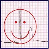 Electrocardiogram Differentiation of Benign Early