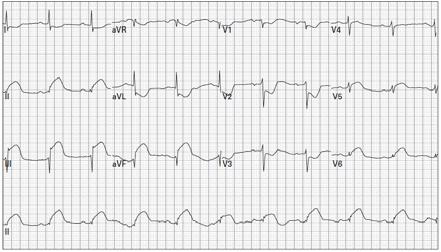 EKG de precordial derivasyonlarda derin