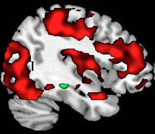 Öncesi ve sonrasında FMRI ile duygusal yüz ifadelerine beyin yanıtı (dikkat test)
