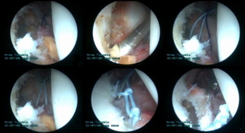 8 Acta Orthop Traumatol Turc (a) (d) (b) (e) içe yöntemi ile epidural iğne kılavuzluğunda akromionun anterior köşesine yakın olacak şekilde rotator intervalden açıldı.