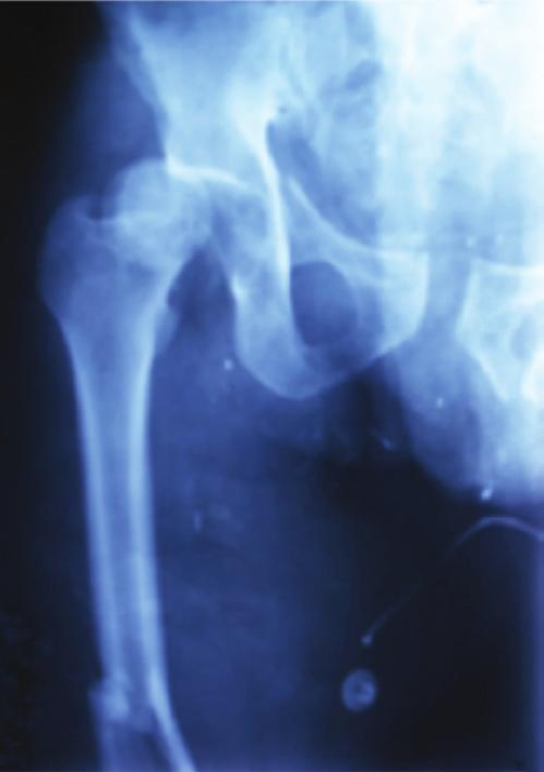 Cerrahide medial parapatellar yaklaşım kullanıldı ve femur şaft kırığı distal femur çivisi ile tespit edildi (Şekil 3a). Daha sonra hasta yan yatırılıp sağ kalça posterolateral yaklaşımla açıldı.