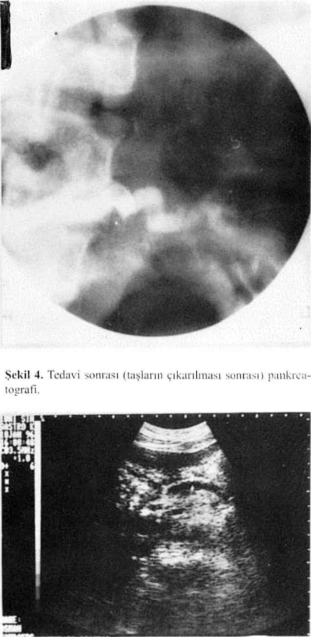 Mchmci Haili YAŞA ve Ark PANKRPAS KANAL. TAŞLARI VI- LN'DOSKOI'İK TİT)\V1 Şekil 3. Pankreas kanal taşlarının balonla çıkarılması. yardımıyla pankreas kanalındaki taşlar başarıyla çıkarıldı.