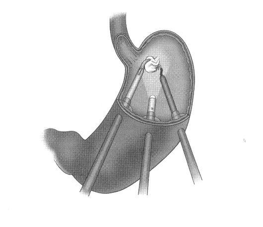 ġekil 8. Erken mide kanseri için laparoskopik intragastrik cerrahi (77) Kobayashi ve ark. (78) sekiz yıllık deneyimlerini sunmuģlar ve uygun olan MK lerinden 7 sine bu yöntemi uygulamıģtır.