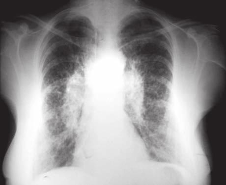 Sarkoidozda akciğer radyografisine göre evreleme yapılmaktadır: 25 Evre 0: normal akciğer grafisi Evre 1: bilateral hiler lenfadenopati (Resim 5) Evre 2: bilateral hiler adenopati ve parankimal