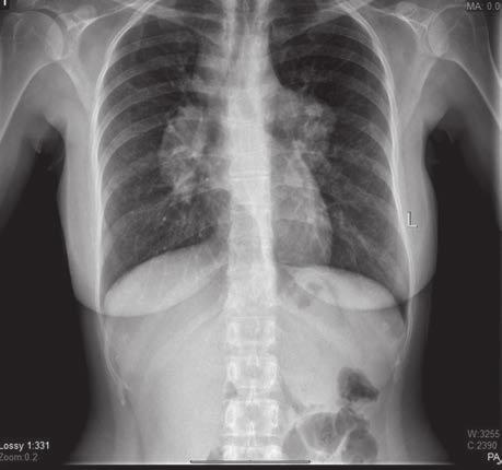 Özellikle ileri evre olgularda pulmoner hipertansiyon gelişebilmektedir. Sarkoidoz sistemik bir hastalık olduğu için, hasta farklı sistemlere ait belirti ve bulgularla başvurabilir.