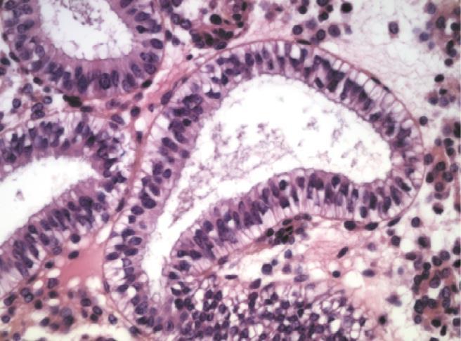 endometrium maturasyonun öne gelmesi, endometrial asenkroni ve implantasyonun bozulması GnRH-a rının direkt