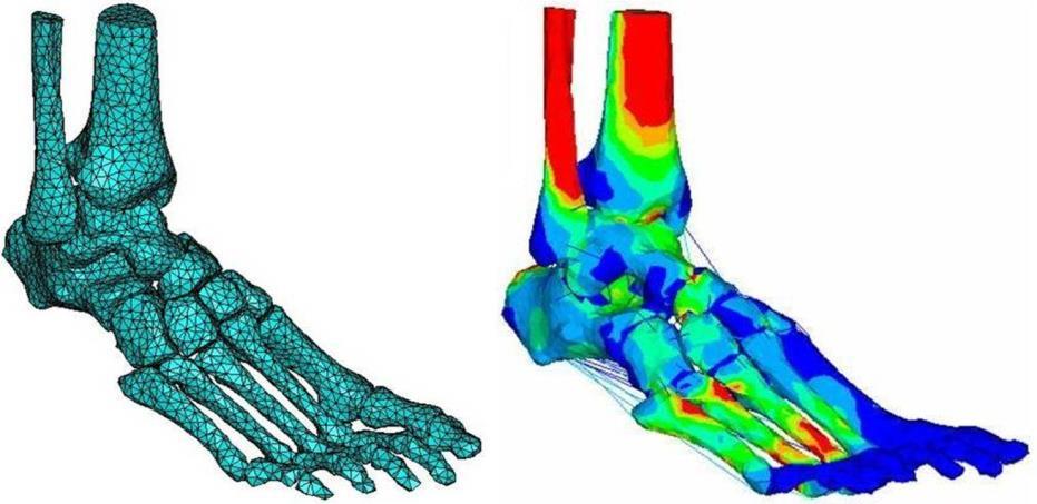 Tibia ve Fibula Kemikleri Sonlu Elemanlar