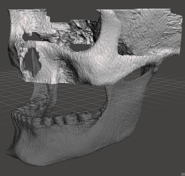 ITK-SNAP Programında CT Görüntülerinden Oluşturulan Model Meshmixer programına aktarılan yüksek boyutlu