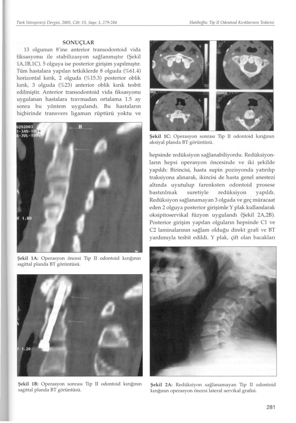 Tiirk Nörosiriirji Dergisi, 2005, Cilt: 15, Sayi: 3, 279-284 Hatibotlii: Tip II Odontoid Kiriklari/iin Tedavisi SONUÇLAR 13 olgunun 8'ine anterior transodontoid vida fiksasyonu ile stabilizasyon