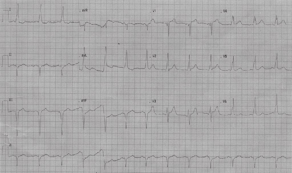 146 Türk Aritmi, Pacemaker ve Elektrofizyoloji Dergisi Giriş 24 yaşında erkek hasta beş yıldır olan çarpıntı yakınması nedeniyle kliniğimize başvurdu.