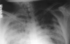 GİRİŞ Transfüzyon sonrası gelişen respiratuar distres sendromuna TRALI (Transfusion Related Acute Lung Injury) adı verilmektedir.