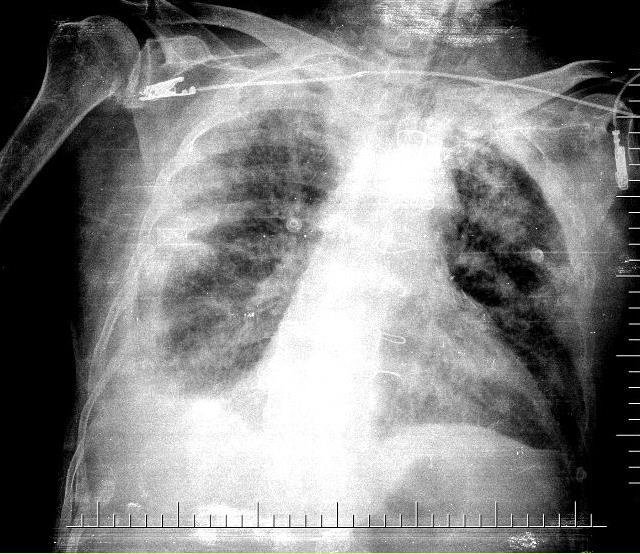 GÖRÜNTÜLEMELER PA AC Grafisi Toraks BT: Akciğer parankim alanları incelemesinde; bilateral akciğerde sağda belirgin olmak üzere plevral belirgin effüzyon izlenmiştir.