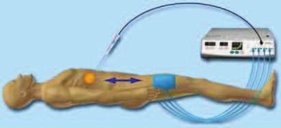 ) yaralanması açısından risk taşımaktadır. 8 RESİM 1: Elektrot tipleri A) Expandable elektrot, B) Cooled tip elektrot, C) bipolar elektrot.