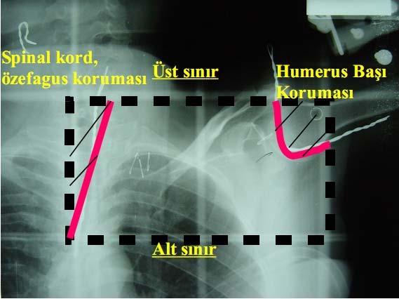 Supraklaviküler alanının medial sınırı sternum orta hattından geçip krikoid kıkırdak hizasında boynu çaprazlar (spinal kord ve özefagus koruması nedeniyle).