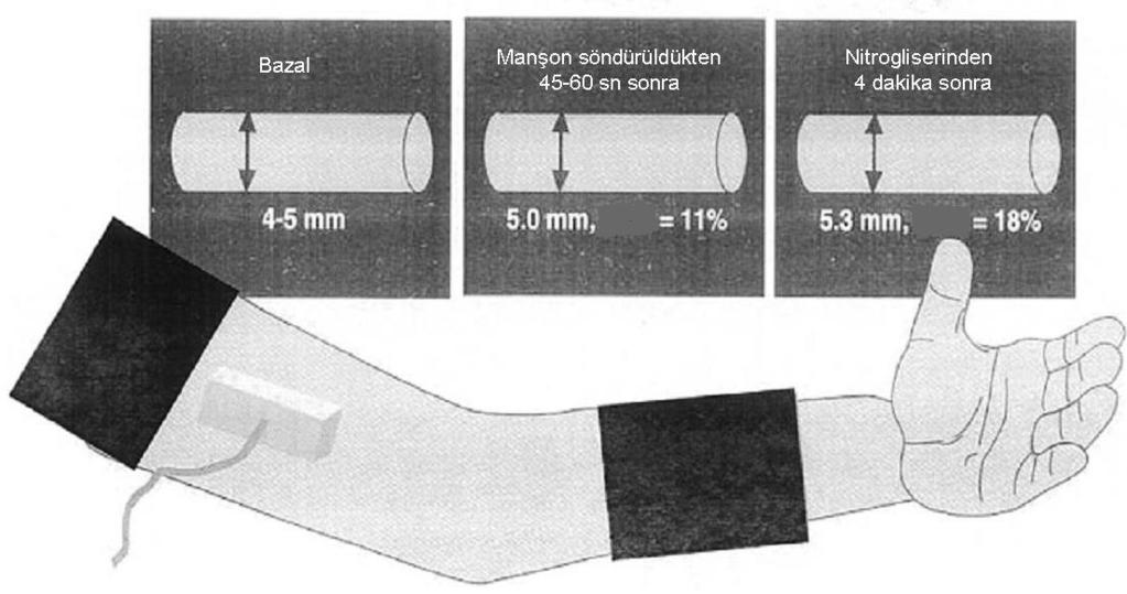 posterior duvar intiması arasındaki mesafenin ölçülmesiyle elde edilir (Şekil 7).