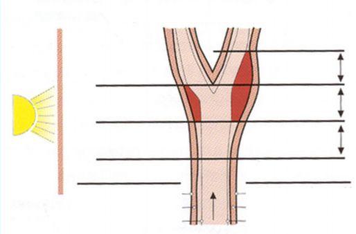 karotis arterlerdeki yakın veya uzak duvardaki çift çizgi görüntülerinden uzak duvardaki görüntünün gerçek olarak intima-media kompleksini yansıttığı gösterilmiştir 175, 176.