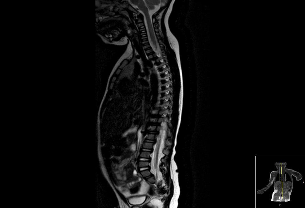 TÜM SPİNAL MR (12/06/2017) Sagittal T2-ağırlıklı