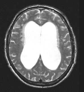 OLGU 4. NBH grubundan 66 y erkek olgu, preoperatif A B C RESİM A, B, C.