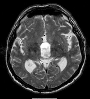 OLGU 5. NBH grubundan 72 y erkek olgu, preoperatif A B C RESİM A, B, C. T1A sagital MRG kesitinde (A) lateral ve 3.