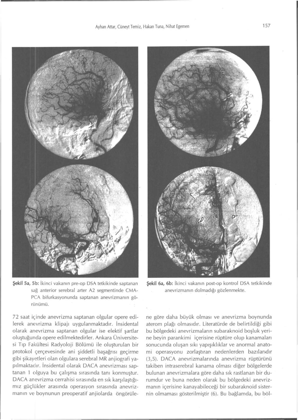 Ayhan Attar, Cüneyt Temiz, Hakan Tuna, Nihat Egemen 157 Şekil 5a, 5b: ikinci vakanın pre-op DSA tetkikinde saptanan sağ anterior serebral arter A2 segmentinde CMA- PCA bifurkasyonunda saptanan