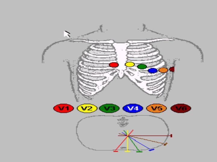 II. Göğüs Derivasyonları V1 : 4. interkostal aralık sternumun sağ kenarı V2 : 4. interkostal aralık sternumun sol kenarı V3 : V2 ile V4 ün ara noktası V4 : 5.