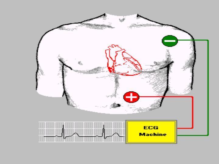 EKG Kaydı I. Bipolar kayıt iki aktif (different) elektrod II.