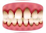 Dişlerin sallanması ve diş eti çekilmesi 5.
