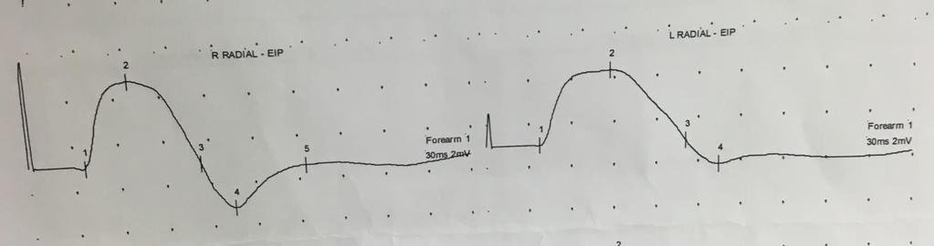 EMG: Solda otor lifleri tuta, hafif akso