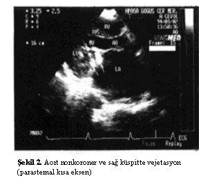 mitralde, 3 hastada aort ve triküspitte, 2 hastada mitral ve triküspitte, 2 hastada 4 kapakta da vejetasyon, 1 hastada sol ve sağ atriumda vejetasyon vardı.