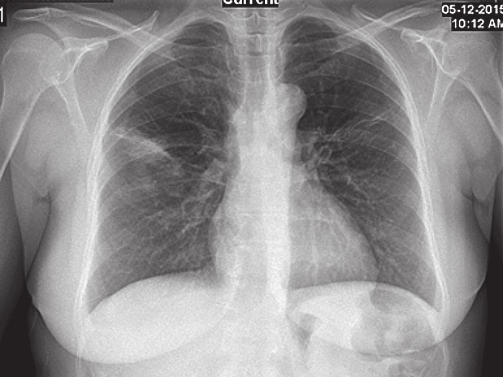 Bilateral hava bronkogramları içeren konsolide