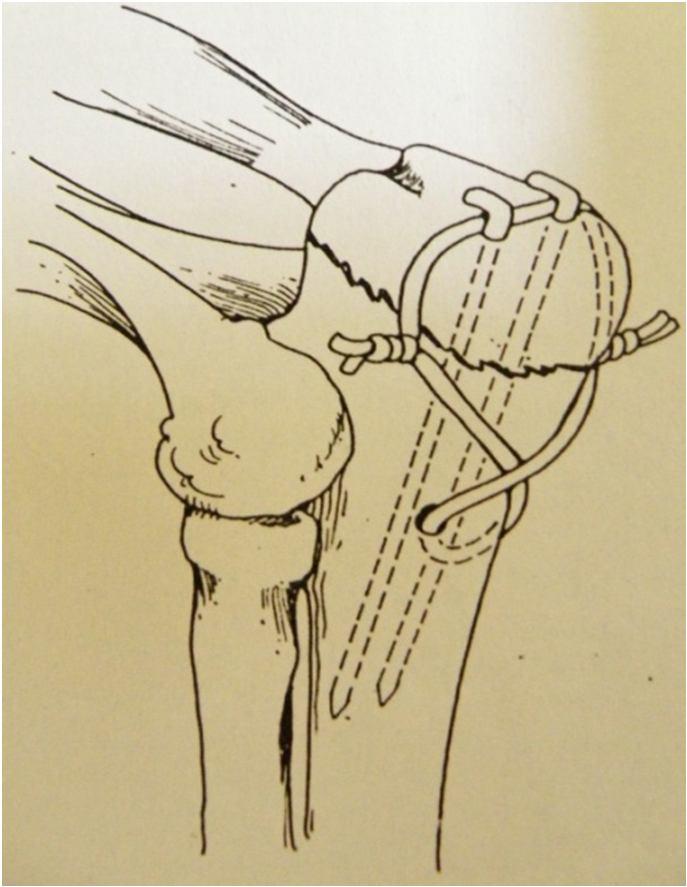 22 Olecranon kırıklarında triceps kaslarının çekme kuvvetine karşı koyabilecek bir teknik uygulanmalıdır (Scott ve Mclaughlin, 2007).