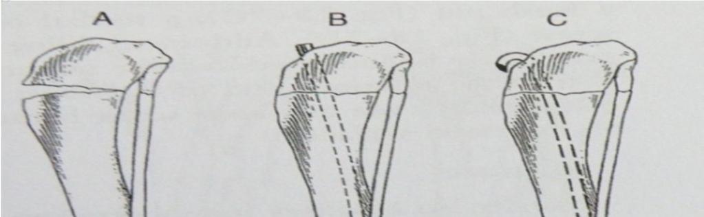 29 izlemekte ve tibia yüzeyindeki interkondiler üst noktaya yakın proksimal tibia dan çıkmaktadır.