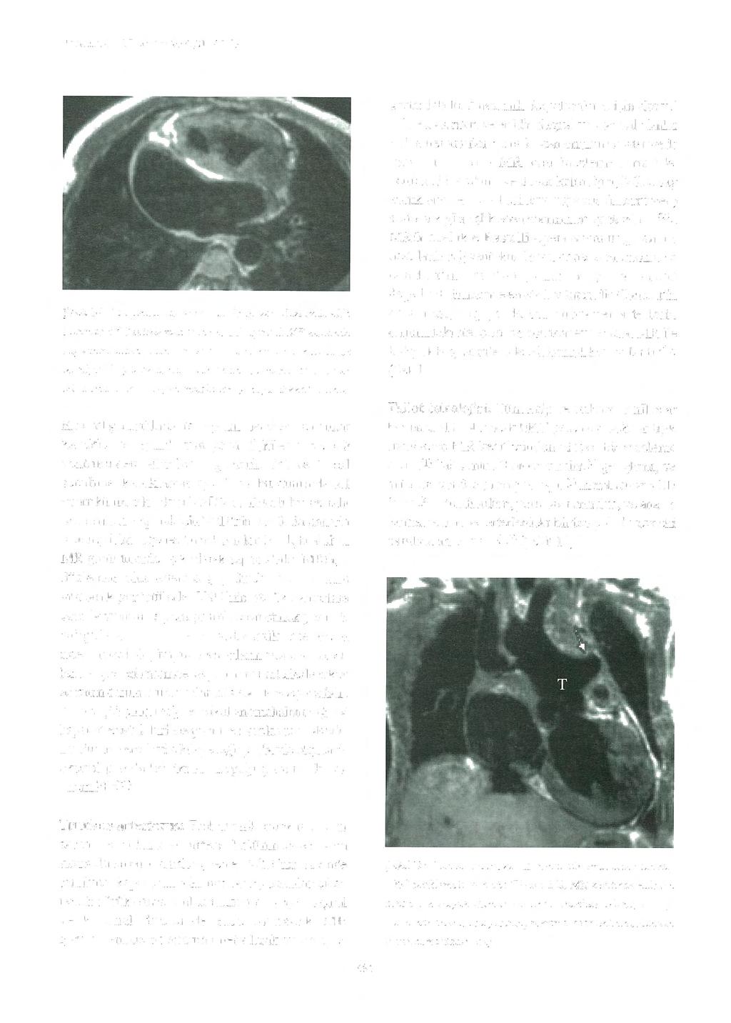 Türk K ard i yol Dem Arş 2003;31 :687-99 Şekili O: Çift ç ıkışlı sağ vemrikiil. Transvers düzlemde elde olunmuş EKG tetiklenıeli spin eko Tl-ağırlıklı MR kesitinde sağ ventrikülden çıkan.