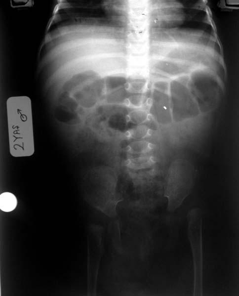 .. vb) çekilmifl pelvis grafilerinde gözlenen ç - k k ve subluksasyon s kl n n saptanmas amaçland.